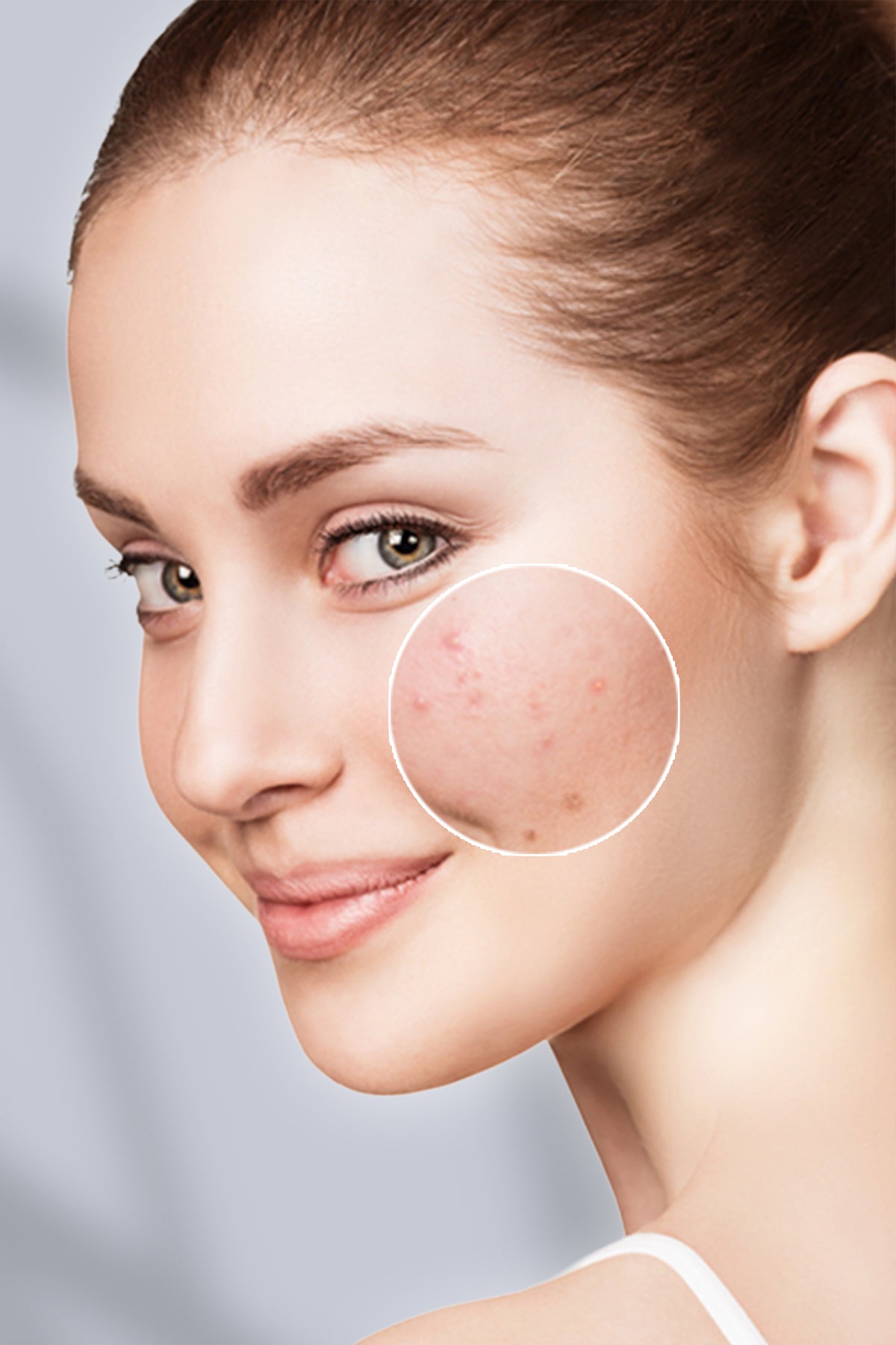 Chaman Acne Control