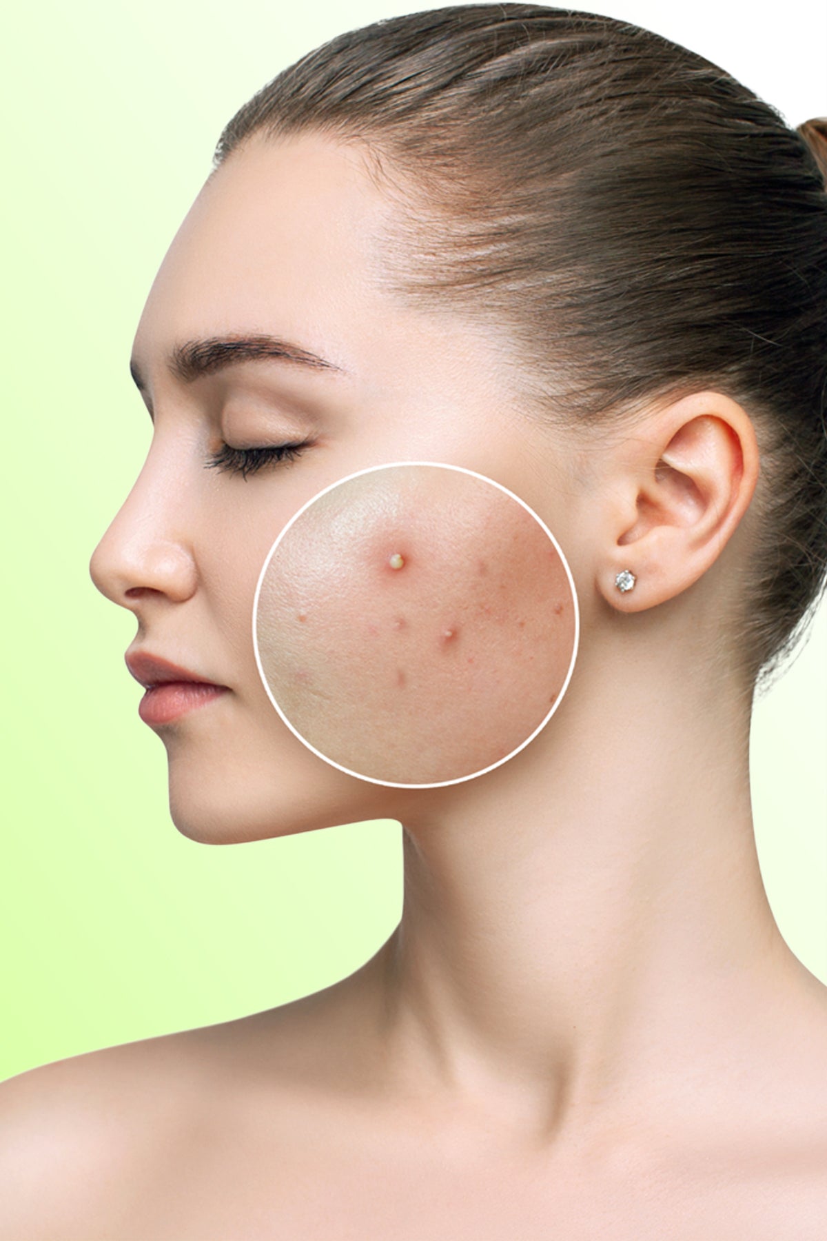 Dollee Acne Clear